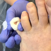 Removed corn on toe with padding